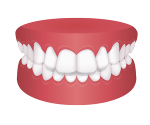 出っ歯(上顎前突)