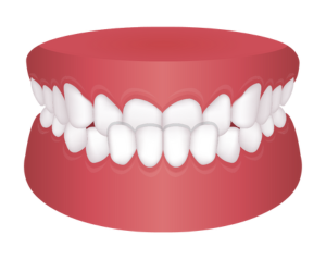 受け口(下顎前突)