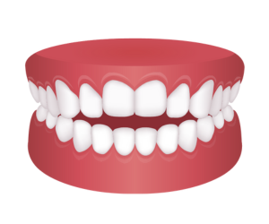 開咬(オープンバイト)