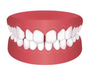 すきっ歯(空隙歯列)